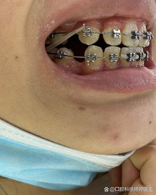 22岁矫正牙齿晚吗?现在矫正还来得及吗?-图1 22岁矫正牙齿晚吗?现在矫正还来得及吗?-图1
