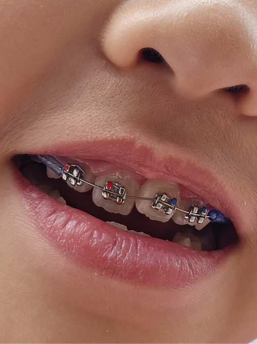 牙齿矫正半年后效果如何?变化明显吗?效果图能体现真实效果吗?-图2 牙齿矫正半年后效果如何?变化明显吗?效果图能体现真实效果吗?-图2