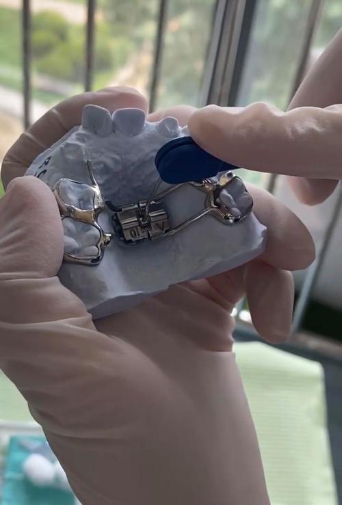 35岁矫正牙齿晚吗？年龄会影响矫正效果吗？-图3