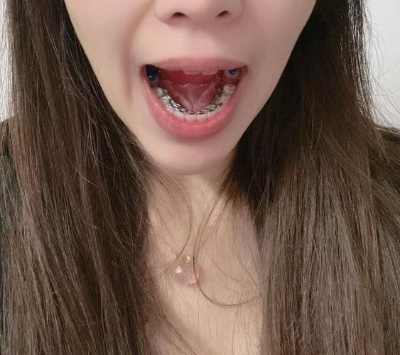 自己用舌头矫正牙齿-图1