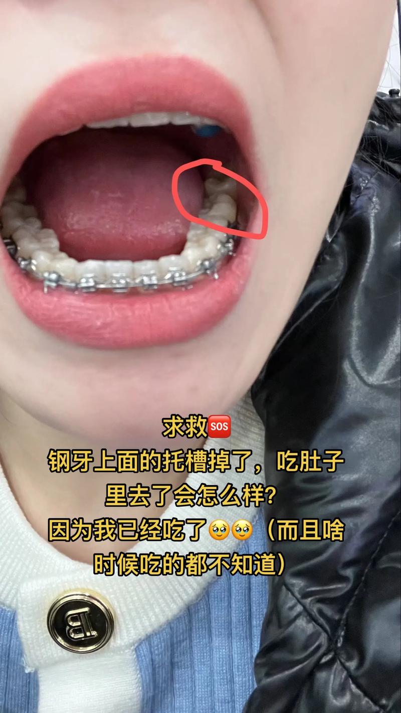 矫正牙齿后吃不了东西，是正常现象吗？怎么缓解？-图1