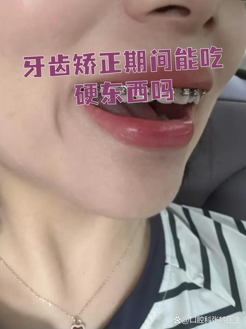 矫正牙齿后吃不了东西，是正常现象吗？怎么缓解？-图3