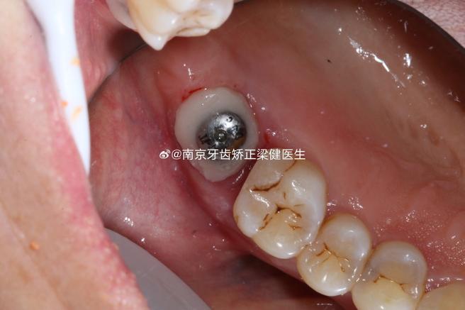 牙齿矫正时种植钉发炎是什么原因？需要如何处理才能继续矫正？-图1