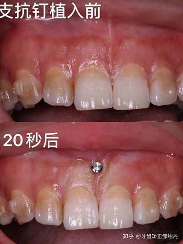 牙齿矫正时种植钉发炎是什么原因？需要如何处理才能继续矫正？-图2