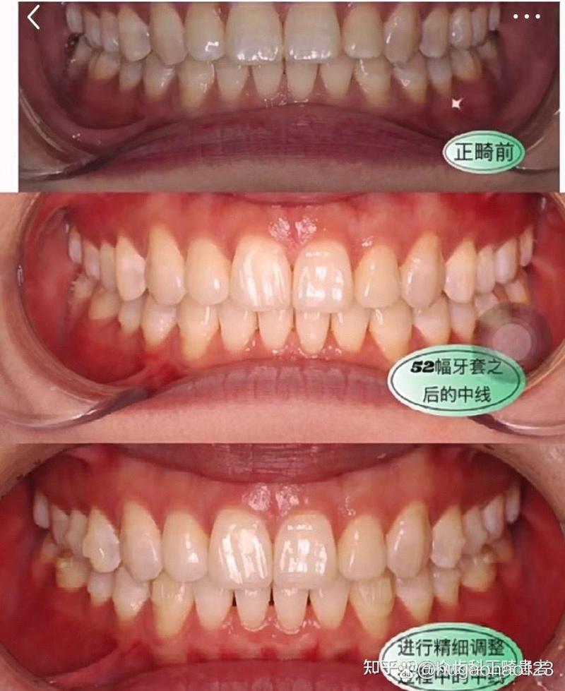 牙齿矫正失败的照片，究竟哪里出了错？-图1
