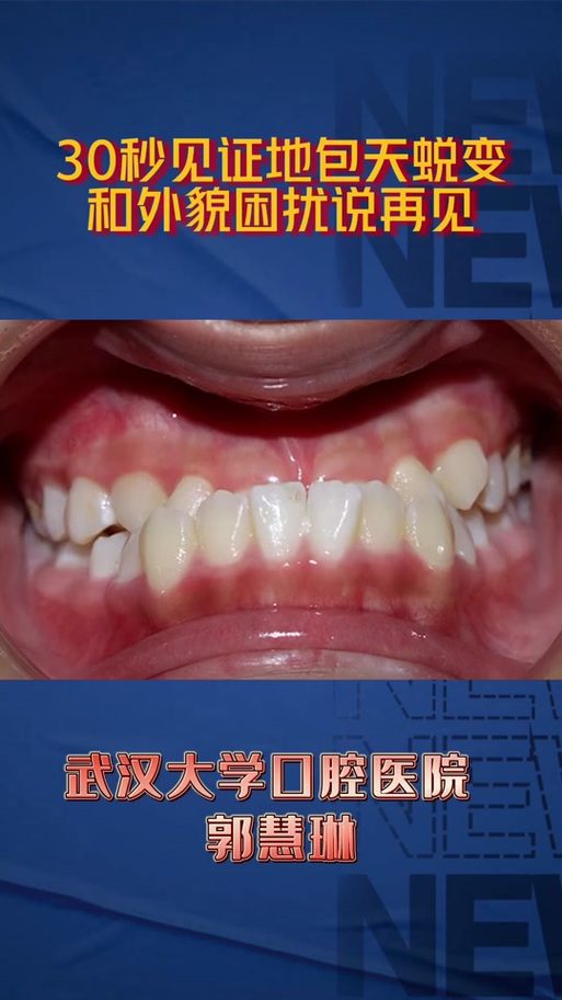 地包天矫正案例效果如何？真实案例分享矫正方法与效果？-图2