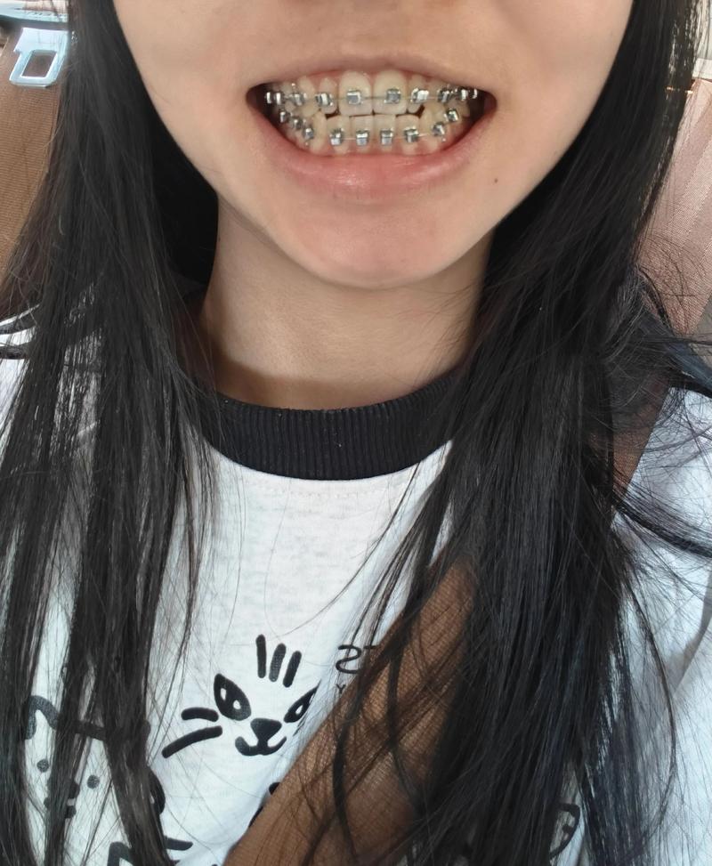 21岁拔牙矫正牙齿-图1