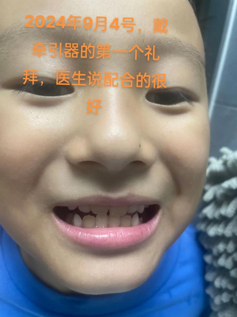 牙齿矫正头套怎么戴才对？新手必看的正确步骤-图3