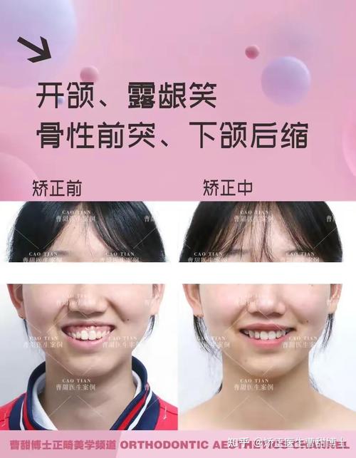 成人矫正牙齿对比图,矫正前后效果差异大吗?-图2 成人矫正牙齿对比图,矫正前后效果差异大吗?-图2