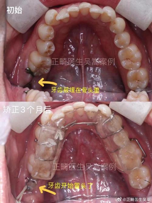 昆山牙齿矫正哪里好-图3 昆山牙齿矫正哪里好-图3