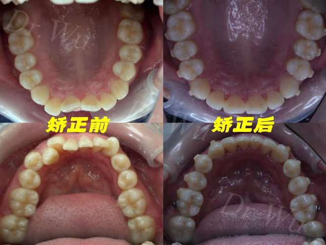 隐形矫正牙齿的坏处，真的像想象中那么少吗？-图1