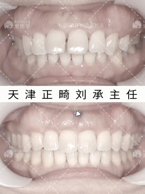 天津牙齿矫正哪里好-图2