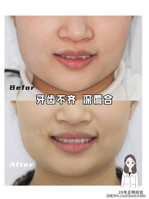 牙齿矫正后咬合不好，是什么原因导致的？该如何处理？-图1