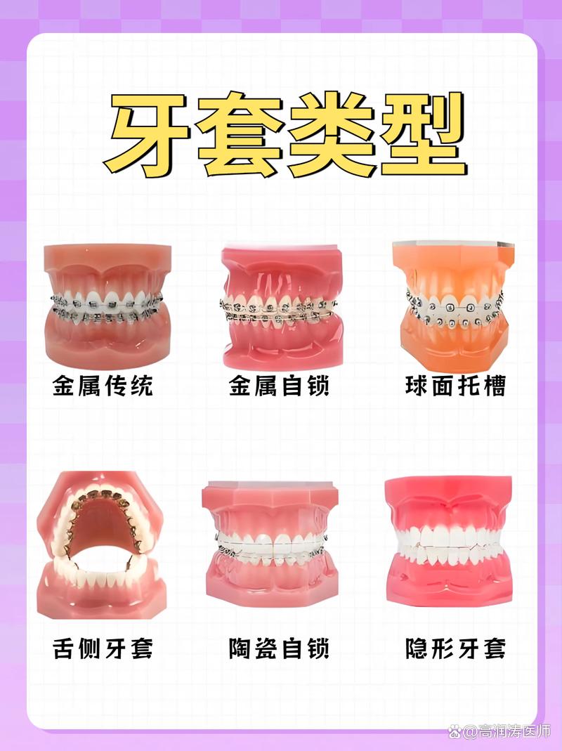 矫正牙齿的材料分哪几种？金属、陶瓷、隐形等哪种更适合自己？-图1
