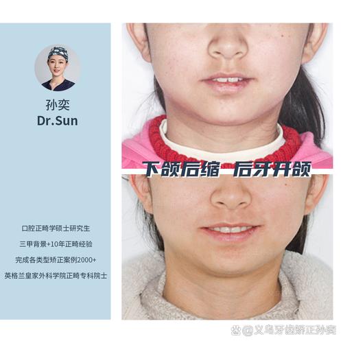 矫正牙齿后中线不齐？原因何在或如何调整？-图3