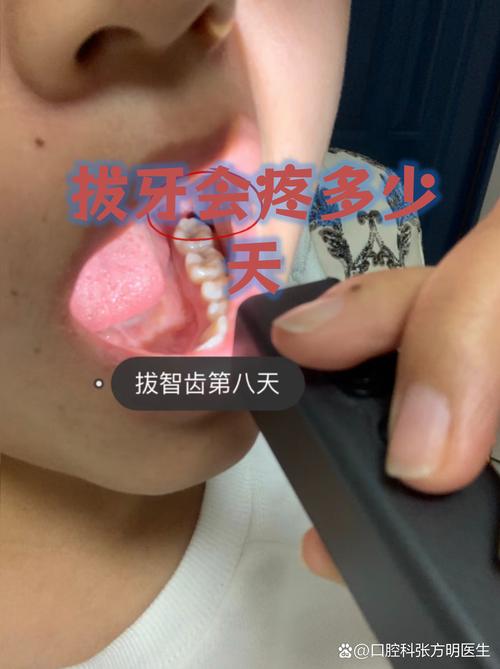 矫正拔牙后疼痛一般持续几天?-图1 矫正拔牙后疼痛一般持续几天?-图1
