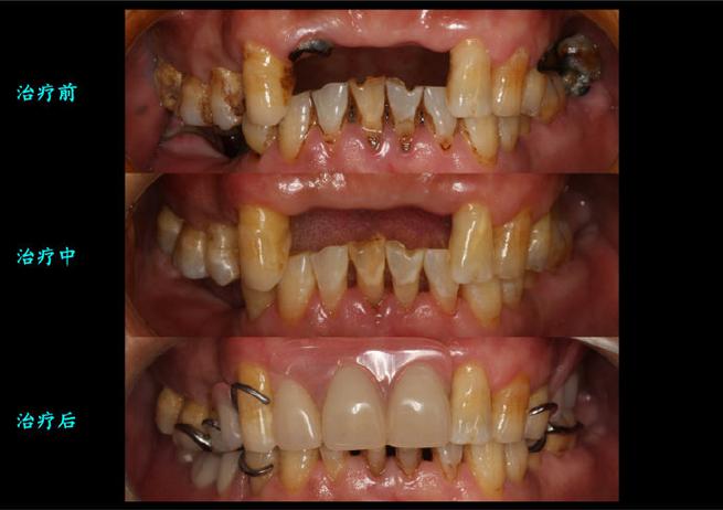 矫正牙齿为何会导致牙神经坏死？-图1