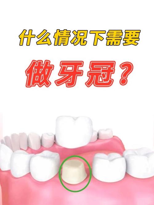 美容冠矫正牙齿的坏处，你了解多少？-图3