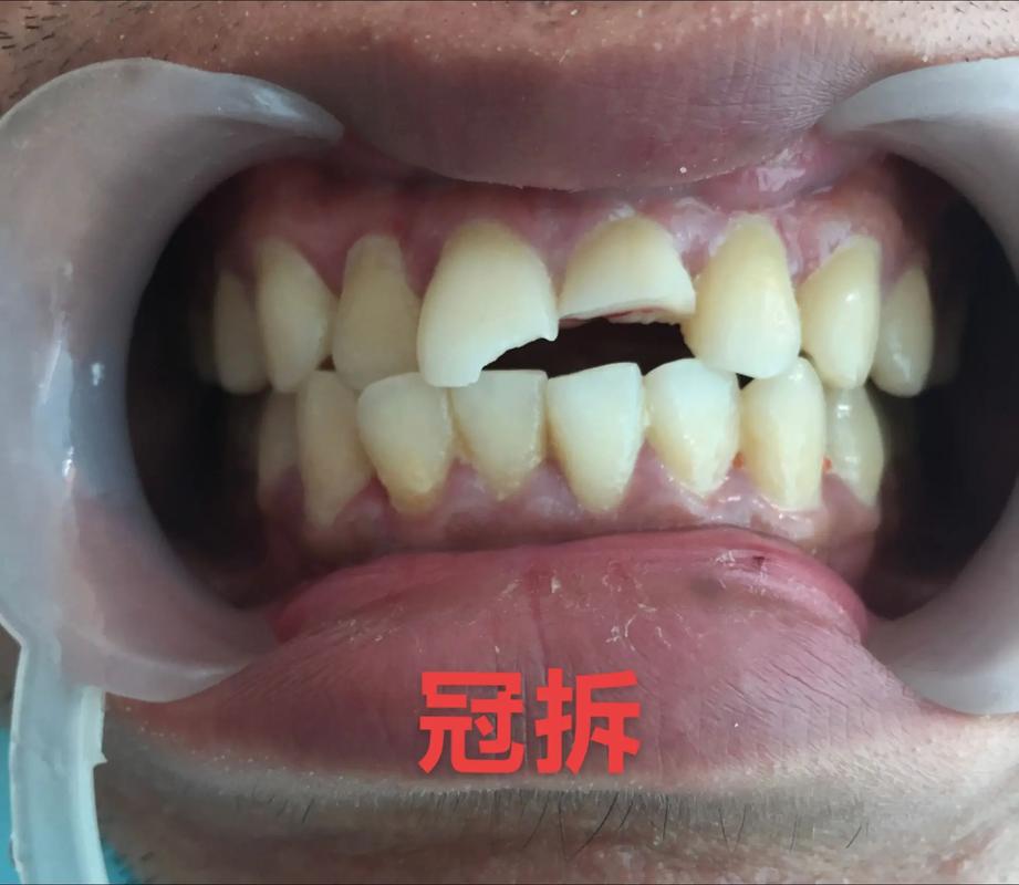 美容冠矫正牙齿的坏处，你了解多少？-图2