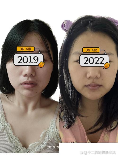 矫正牙齿拔牙脸颊凹-图1