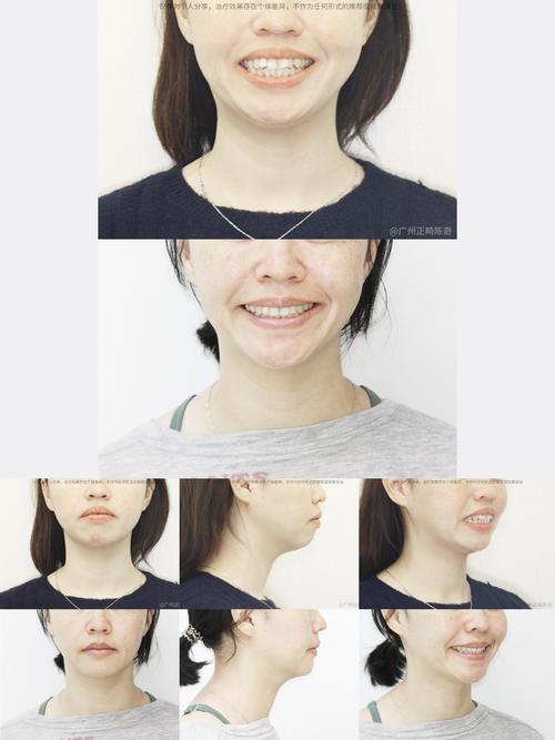 矫正牙齿拔牙脸颊凹-图3