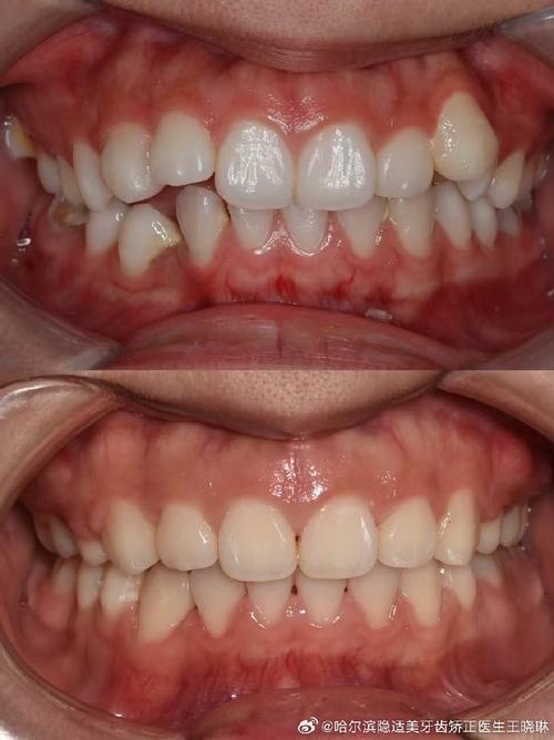 矫正后咬合不齐？原因何在或如何补救？-图2