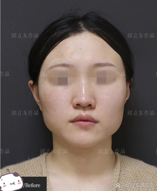 矫正牙齿后脸不对称-图2