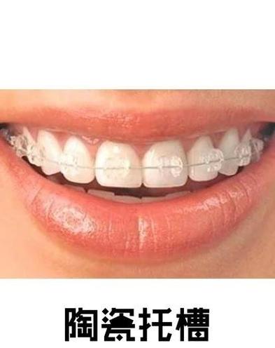 矫正牙齿去哪比较好-图2 矫正牙齿去哪比较好-图2