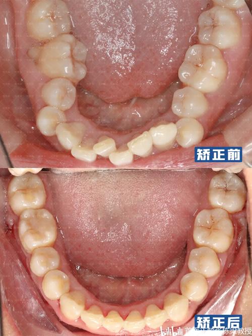矫正牙齿导致脸歪，是矫正出了问题吗？-图2
