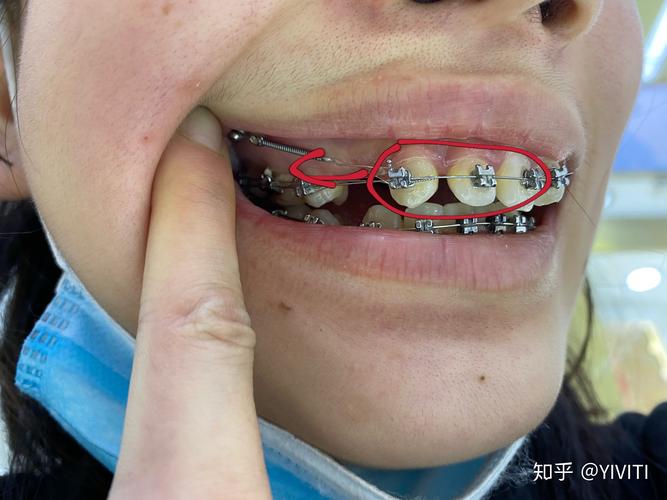 上海哪的牙齿矫正好-图2