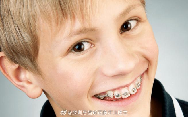 深圳青少年牙齿矫正，几岁开始矫正最合适？效果如何？-图3