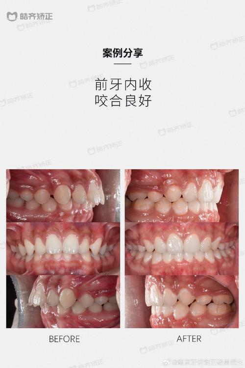 南京哪里牙齿矫正好-图2
