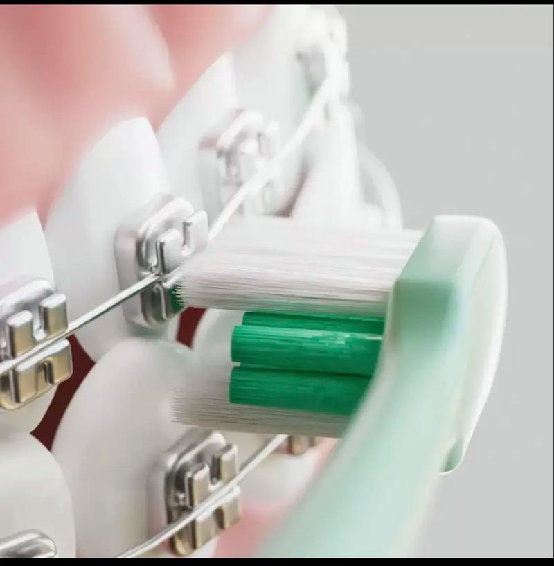 矫正牙齿用什么牙刷-图1