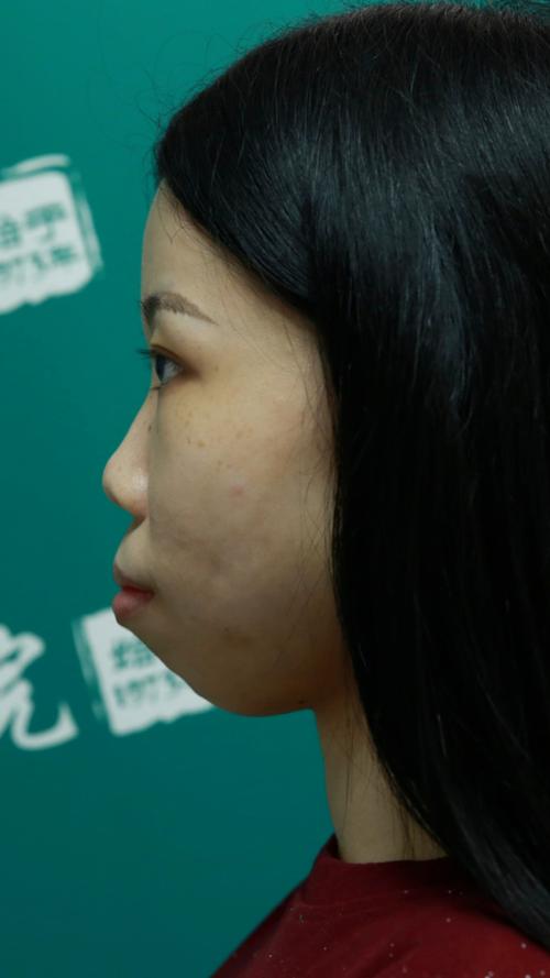 牙齿矫正后嘴巴突出-图1