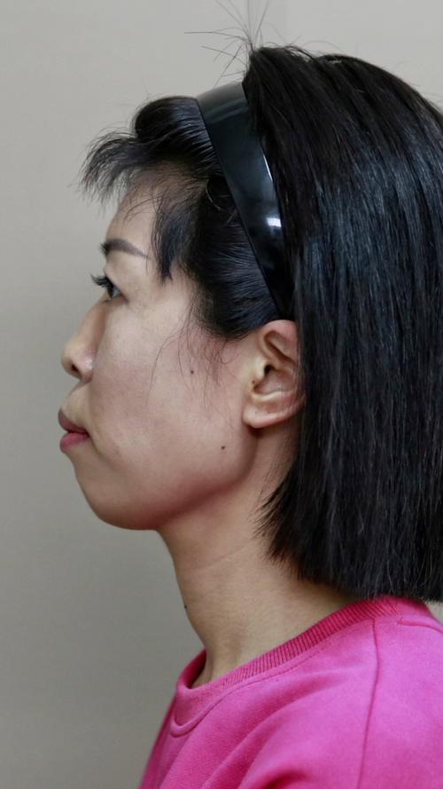 牙齿矫正后嘴巴突出-图3