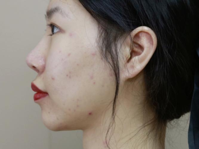 牙齿矫正后嘴巴突出-图2