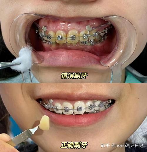 丽水矫正牙齿哪里好-图2