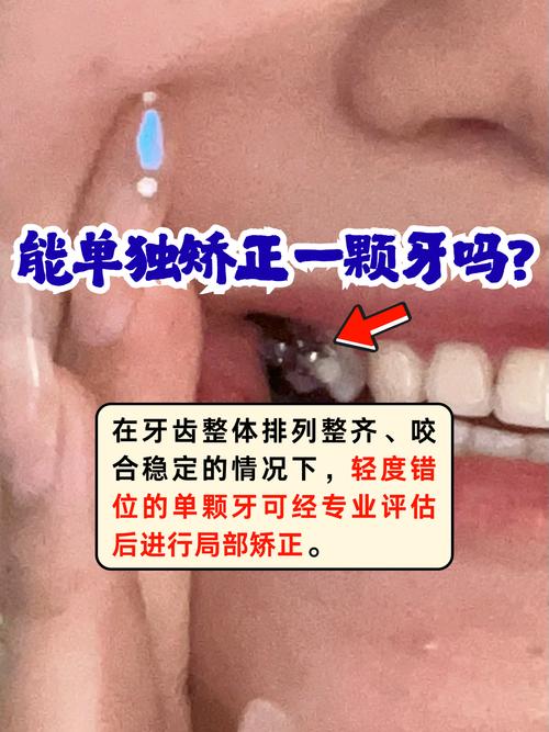 牙齿可以单个矫正吗？单个矫正可行吗？-图2