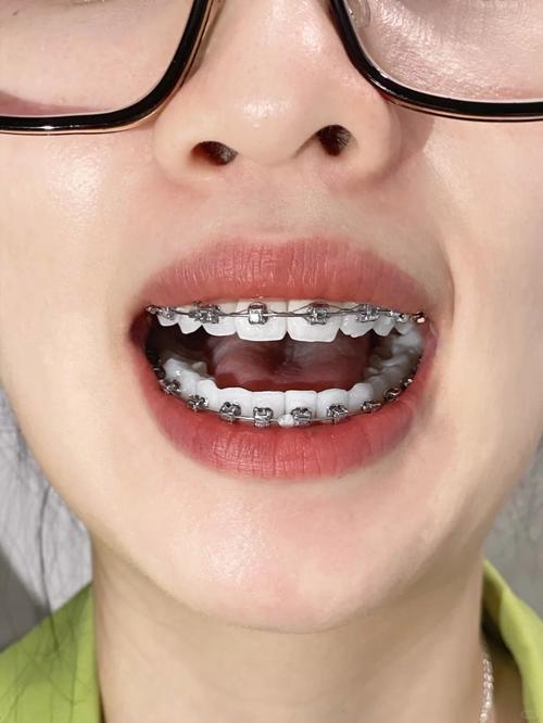 牙齿矫正后牙齿变大-图3 牙齿矫正后牙齿变大-图3