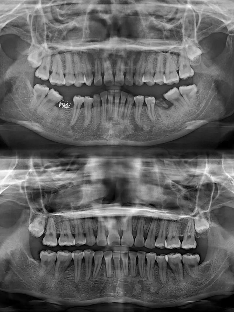 牙套矫正牙齿有用吗-图2
