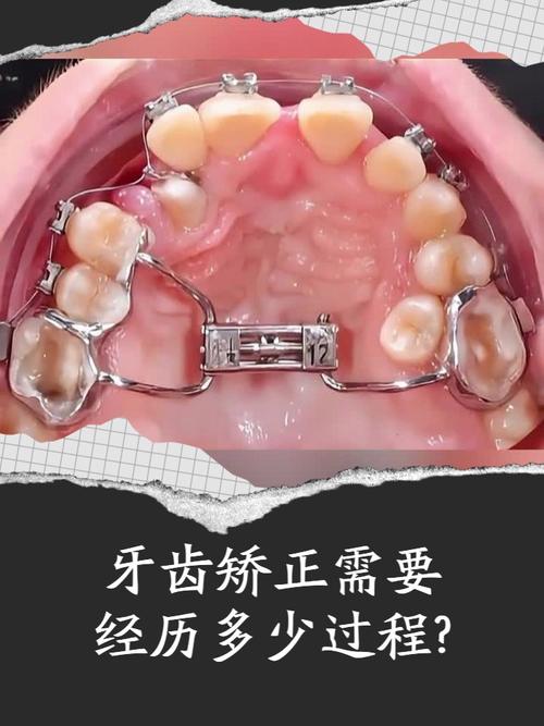 牙箍矫正牙齿的过程-图3