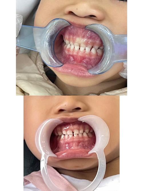 儿童牙齿功能矫正器效果如何？安全吗？-图2