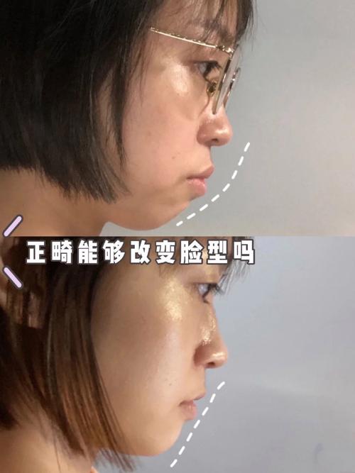 牙齿矫正脸型会变丑-图2