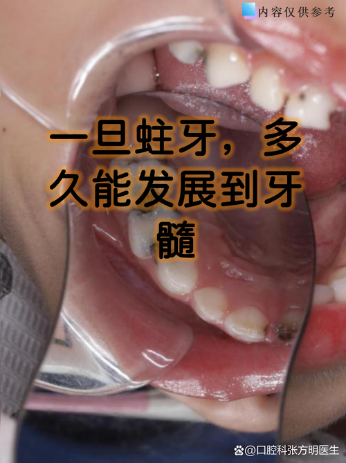 蛀牙未补能直接做牙齿矫正吗？-图2