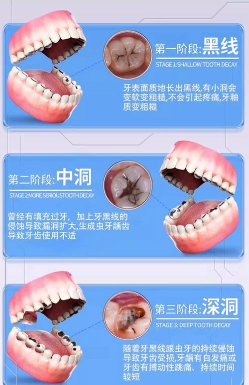 蛀牙未补能直接做牙齿矫正吗？-图1