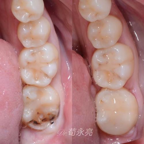 蛀牙未补能直接做牙齿矫正吗？-图3