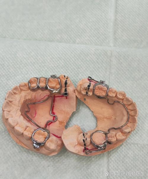 矫正门牙缝大，是什么原因？如何有效解决？-图2