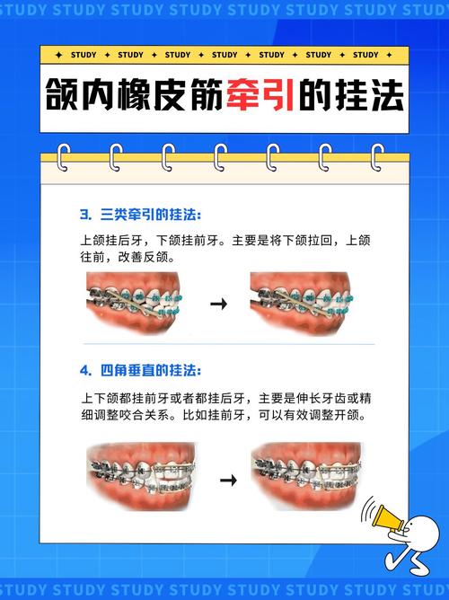 牙齿矫正橡皮链的作用到底是什么？-图1