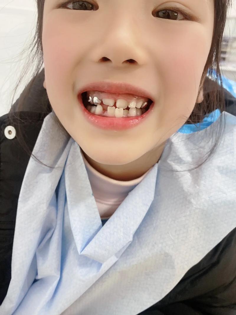 矫正器 牙齿 断了-图1