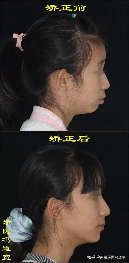 南京牙齿矫正哪家好？如何挑选靠谱机构？-图1
